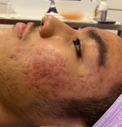 acne-problems-and-deep-scarring-on-a-teenage-boy-f-2022-08-01-04-24-00-utc