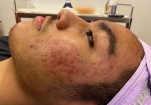 acne-problems-and-deep-scarring-on-a-teenage-boy-f-2022-08-01-04-24-00-utc