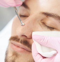 Extreme close-up of man nose during deep pore cleansing procedure with uno spoon